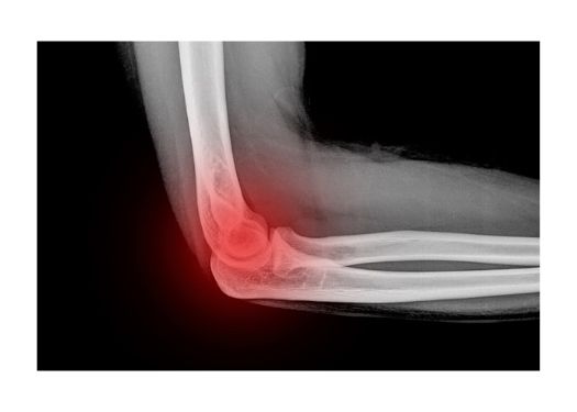 Arthroscopic Treatment Of Elbow Osteoarthritis And Post Traumatic