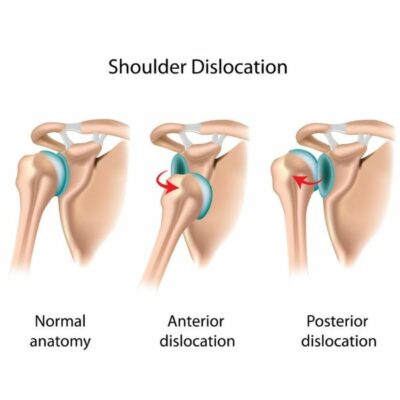 Dislocated Shoulder and Shoulder Instability