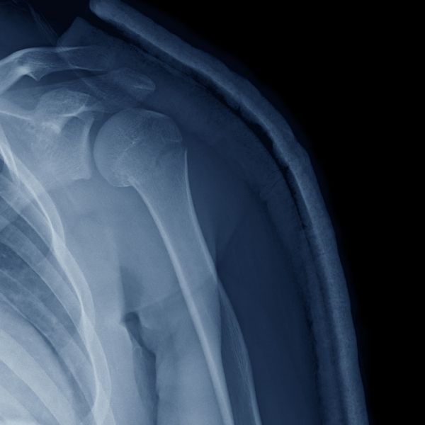 Proximal Fracture Of The Humerus
