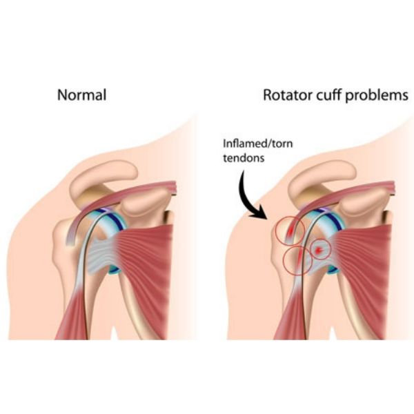 Telltale Signs You Might Have Rotator Cuff Tear : Orthopedic