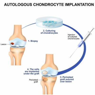 Autologous Chondrocyte Implantation (ACI)