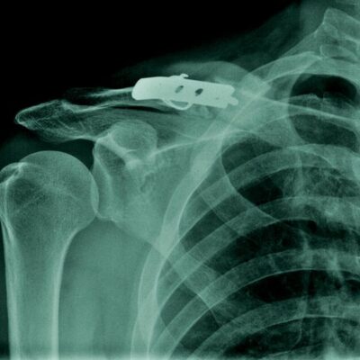 Clavicle Fracture Surgery