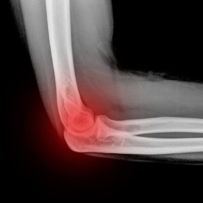 Arthritis of the Elbow | Rheumatoid arthritis | Osteoarthritis