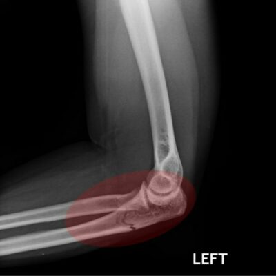 Elbow Fracture
