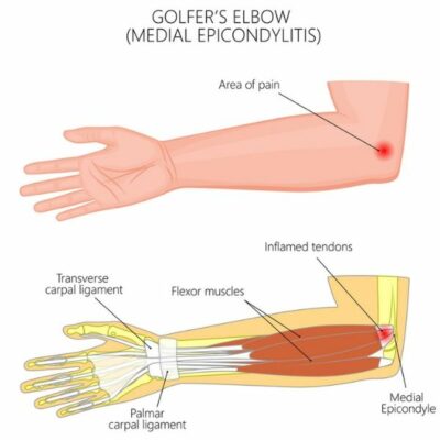 Medial Epicondylitis | Golfer's Elbow