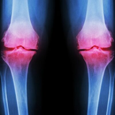 Subchondral Insufficiency Fractures | Subchondroplasty