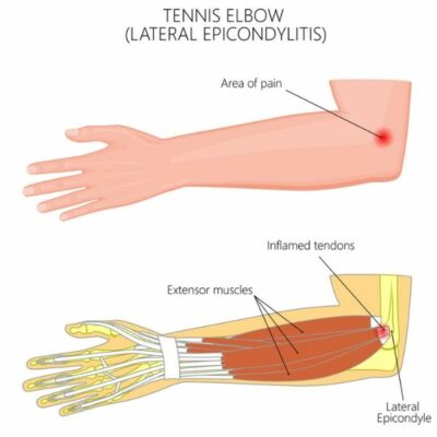 Tennis Elbow | Lateral Epicondylitis