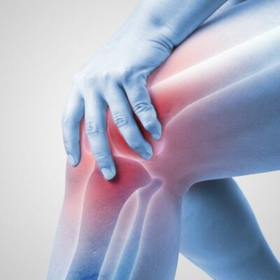 Focal Arthritis of the Knee