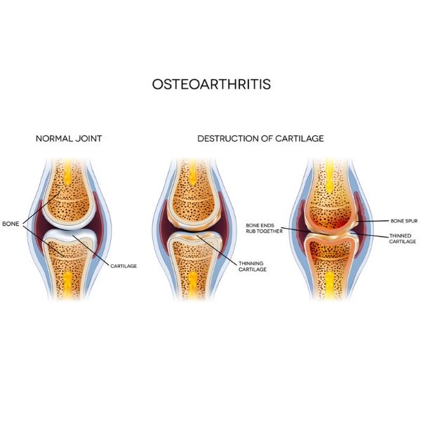 Osteoarthritis - Connecticut Orthopaedics