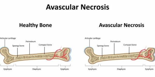Osteonecrosis of the Knee | Avascular Necrosis (AVN) | Aseptic Necrosis | Ischemic Necrosis