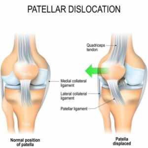 Patellar Instability | Patellar Dislocation