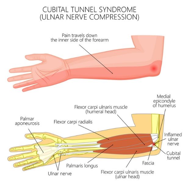 Points of ulnar nerve compression in CuTS.