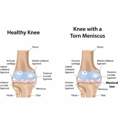 Meniscus Tear | Meniscal Deficiency of the Knee