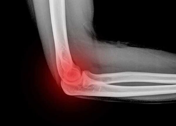 Olecranon Fracture Broken Elbow Specialist South Windsor Enfield Glastonbury Hartford Ct